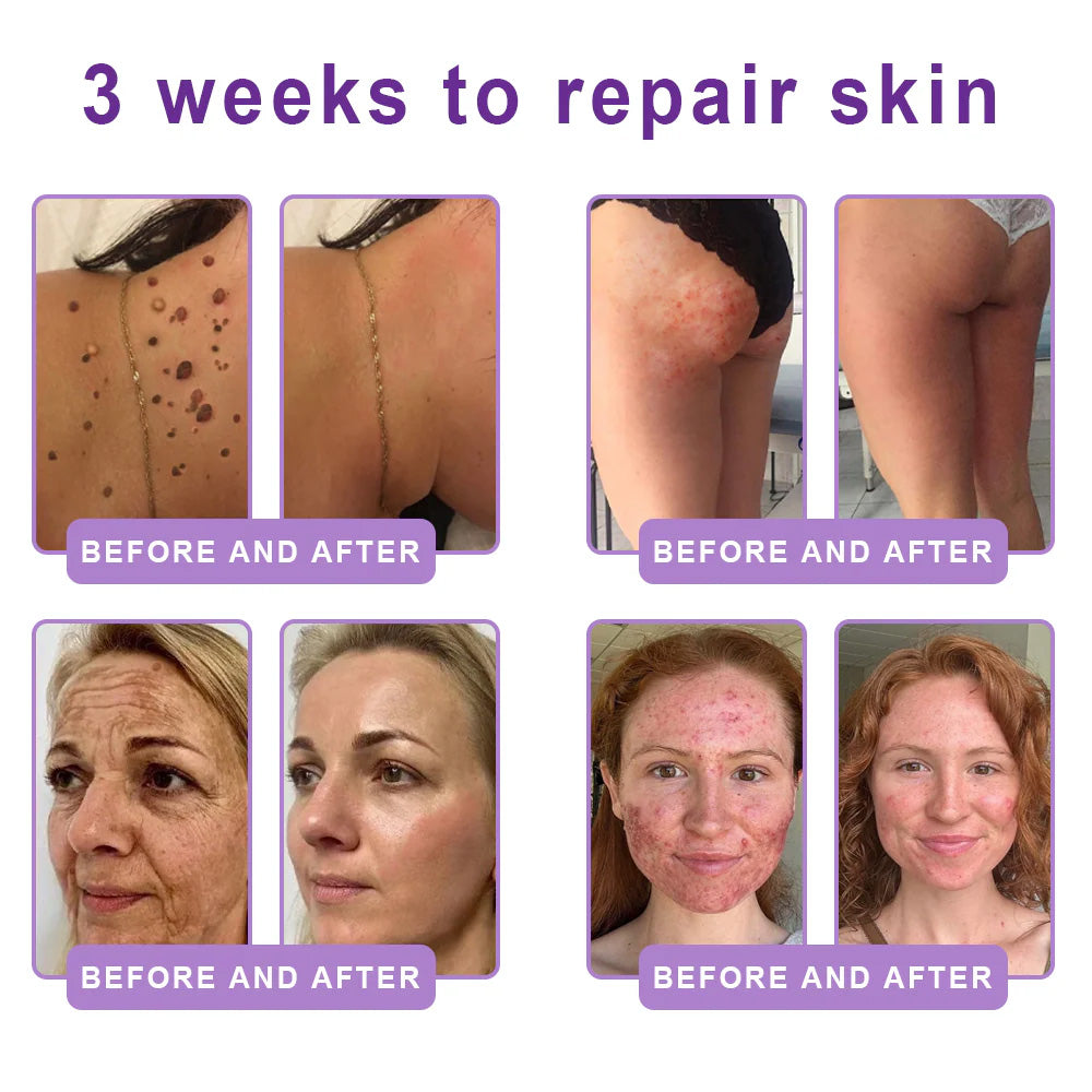 Purelora® 🍅PDRN Multi-Peptide Massaging Body Roller Cream- Anti-aging, Hydrating, Skin Firming & Lifting, Skin Repair, Even Tone, Acne and Dark Spot Treatment, Wart and Mole Removal, and Psoriasis Relief.