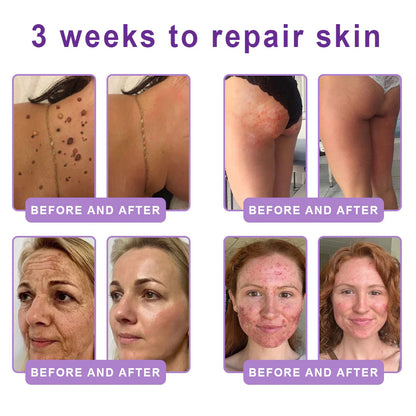 Purelora® 🍅PDRN Multi-Peptide Massaging Body Roller Cream- Anti-aging, Hydrating, Skin Firming & Lifting, Skin Repair, Even Tone, Acne and Dark Spot Treatment, Wart and Mole Removal, and Psoriasis Relief.