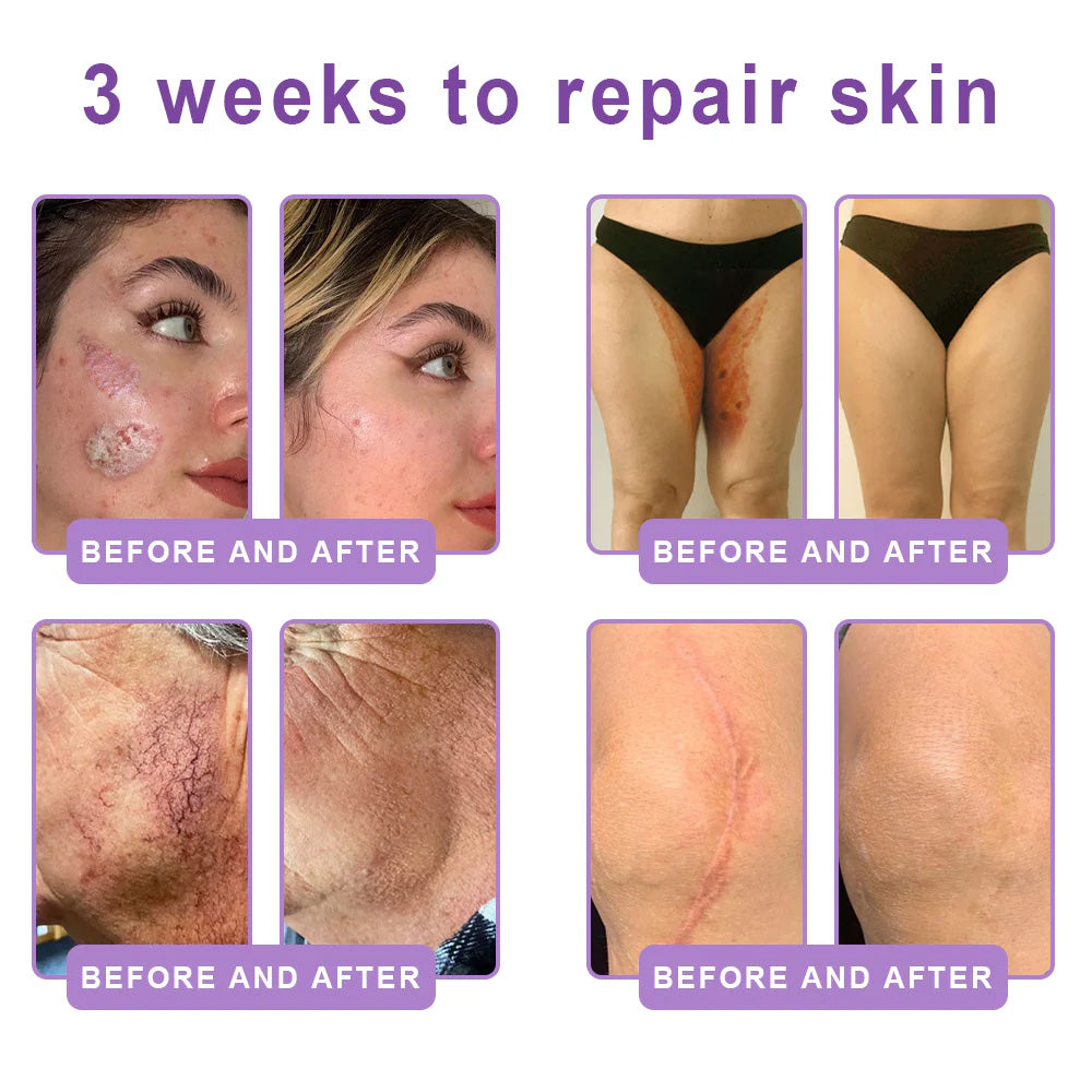 Purelora® 🍅PDRN Multi-Peptide Massaging Body Roller Cream- Anti-aging, Hydrating, Skin Firming & Lifting, Skin Repair, Even Tone, Acne and Dark Spot Treatment, Wart and Mole Removal, and Psoriasis Relief.