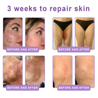 Purelora® 🍅PDRN Multi-Peptide Massaging Body Roller Cream- Anti-aging, Hydrating, Skin Firming & Lifting, Skin Repair, Even Tone, Acne and Dark Spot Treatment, Wart and Mole Removal, and Psoriasis Relief.