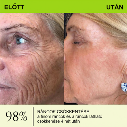[🔥Utolsó nap 70% kedvezmény] Purelora® Botox és Retinol injekció - Radír mély ráncokra, megereszkedett toka és duzzadt szemek ellen