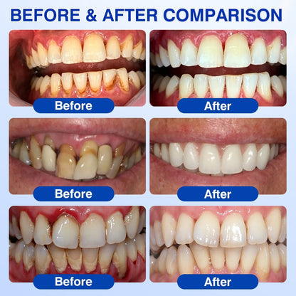 🇦🇺🦷Curalona® GumRevive Periodontal Repair Gel (For Bleeding Gums, Gum Recession & Loose Teeth)+ 🎁 FREE Gum Care Kit