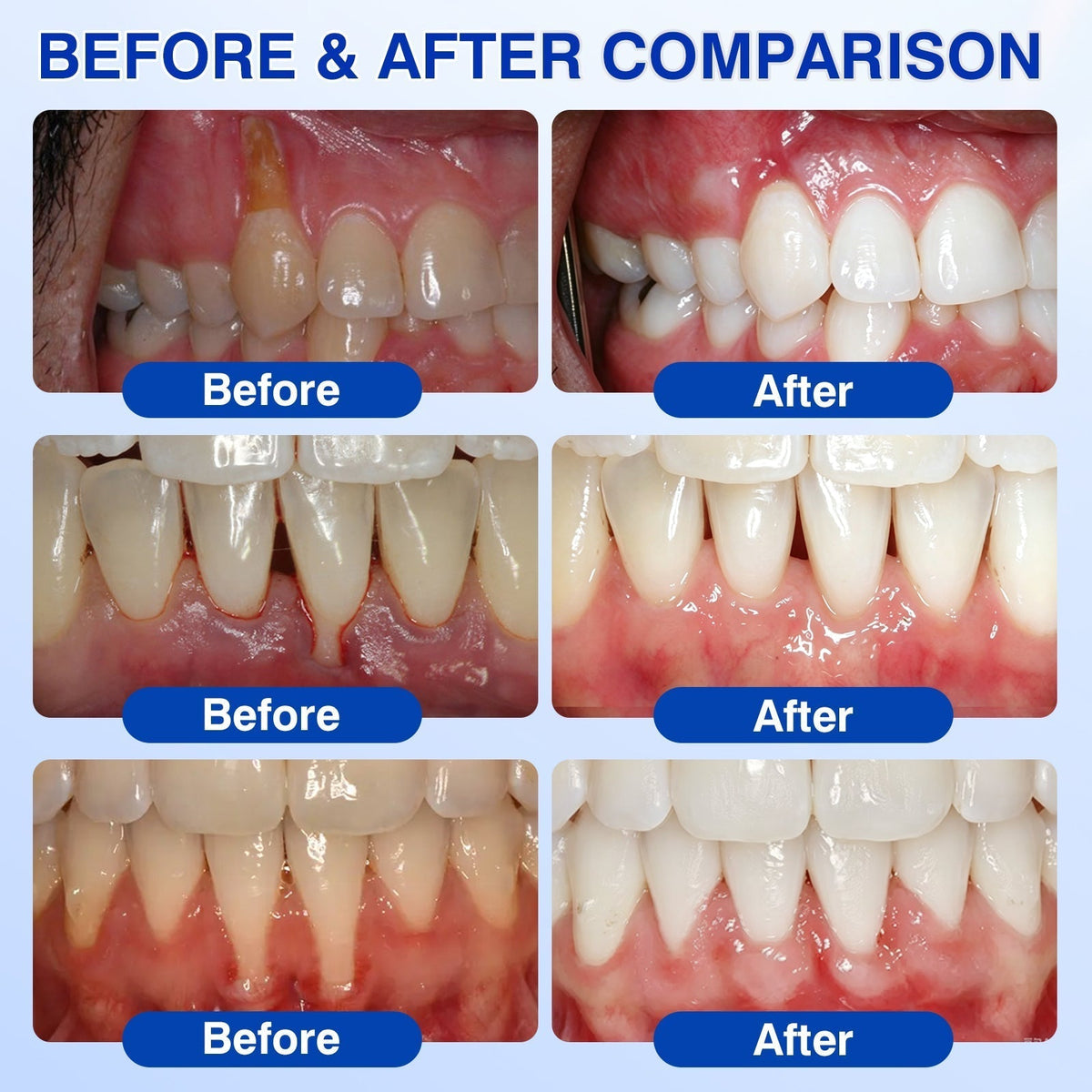 🇦🇺🦷Curalona® GumRevive Periodontal Repair Gel (For Bleeding Gums, Gum Recession & Loose Teeth)+ 🎁 FREE Gum Care Kit