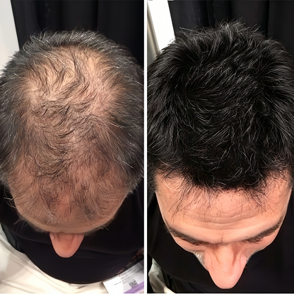 🌿👨‍⚕️ Official Australian Flagship Store 🇦🇺 | 🔥PURELORA® Onion & Rosemary 2-in-1 Anti-Hair Loss & Growth Set — Infused with a 15x concentrated hair-growth active complex to help you achieve thicker, fuller, and stronger hair.