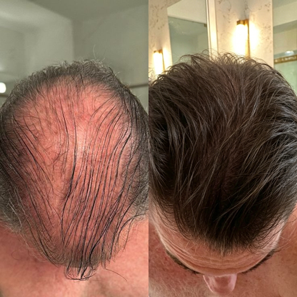 🌿👨‍⚕️ Official Australian Flagship Store 🇦🇺 | 🔥PURELORA® Onion & Rosemary 2-in-1 Anti-Hair Loss & Growth Set — Infused with a 15x concentrated hair-growth active complex to help you achieve thicker, fuller, and stronger hair.