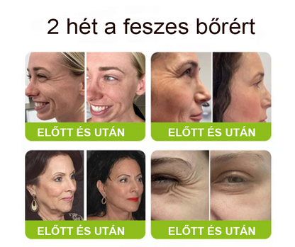 [🔥Utolsó nap 70% kedvezmény] Purelora® Botox és Retinol injekció - Radír mély ráncokra, megereszkedett toka és duzzadt szemek ellen