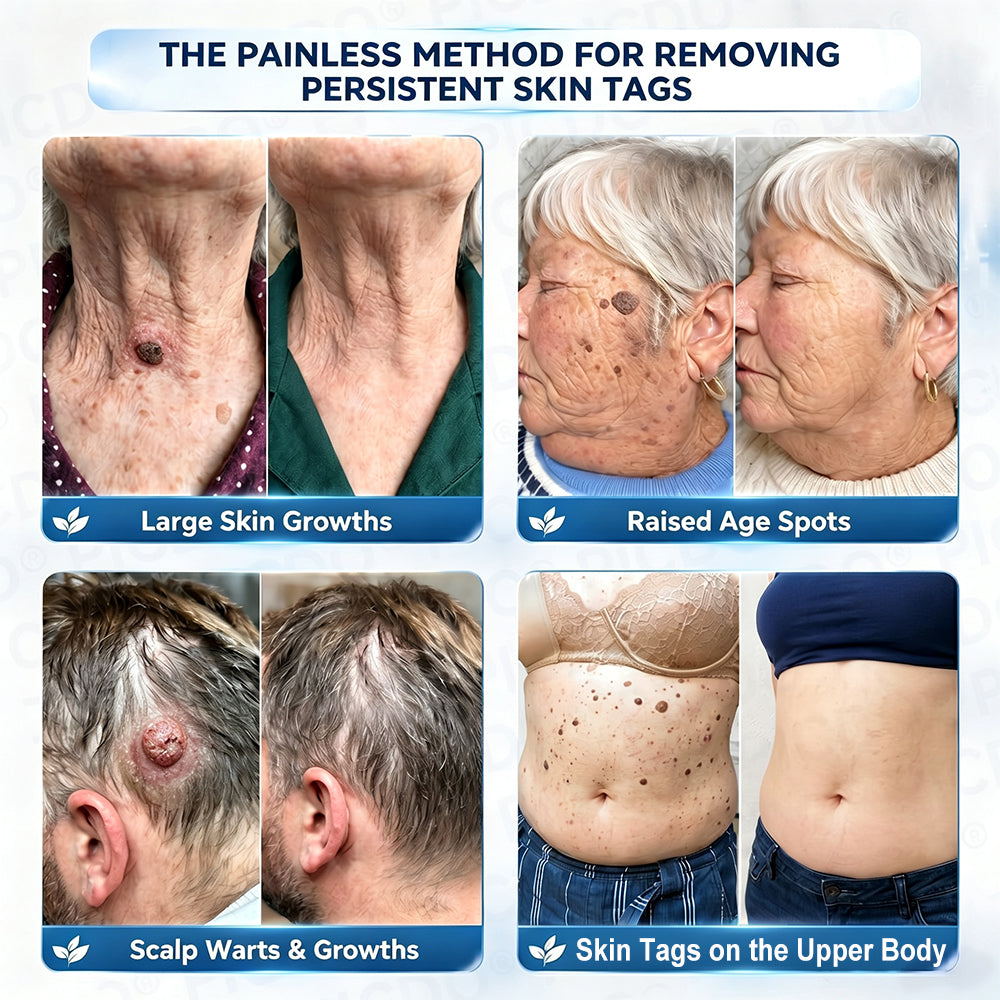 Purelora®  7-Day Skin Tag & Blemish Removal Cream (Painless Formula – Scar-Free)🌹🌹