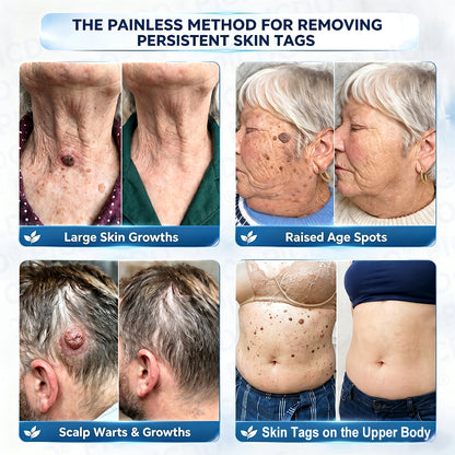 Purelora®  7-Day Skin Tag & Blemish Removal Cream (Painless Formula – Scar-Free)🌹🌹