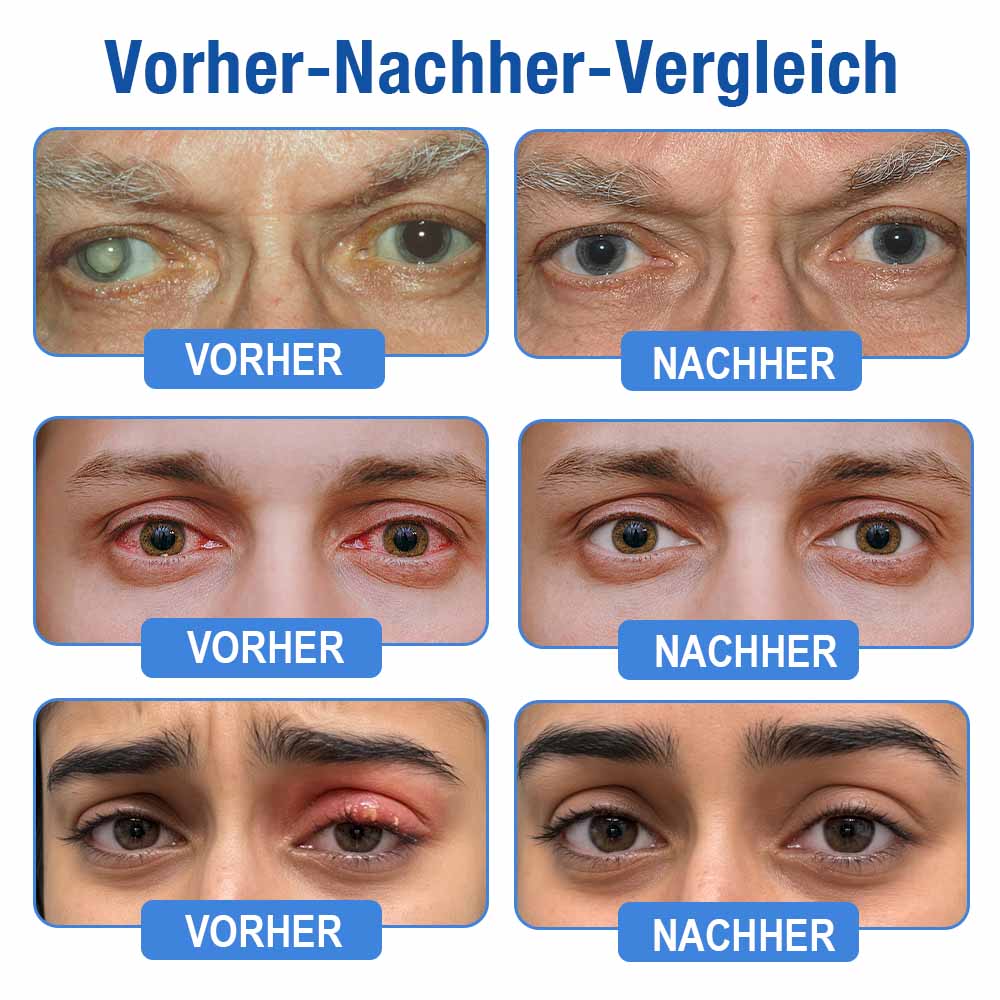 👨‍⚕️𝐏𝐔𝐑𝐄𝐋𝐎𝐑𝐀® LensClarity Eye Drops✅For dry eyes, blurry vision & presbyopia 💦