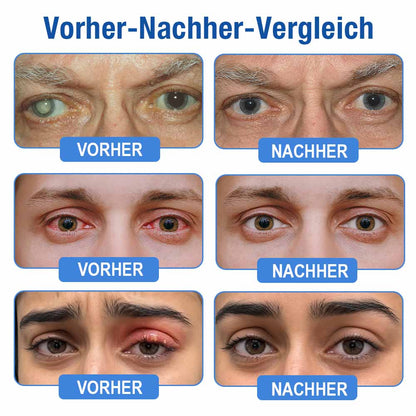👨‍⚕️𝐏𝐔𝐑𝐄𝐋𝐎𝐑𝐀® LensClarity Eye Drops✅For dry eyes, blurry vision & presbyopia 💦