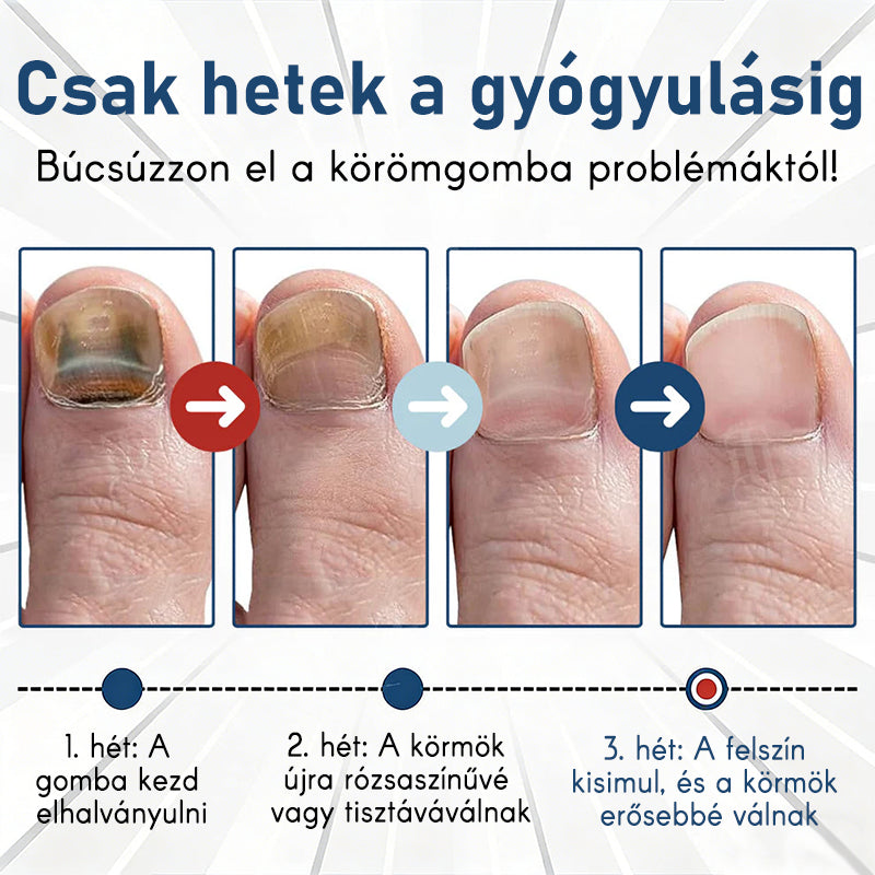 Purelora®Bioaktív Mélyen Behatoló Rendszer Körömgomba Ellen