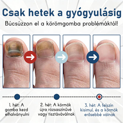 Purelora®Bioaktív Mélyen Behatoló Rendszer Körömgomba Ellen