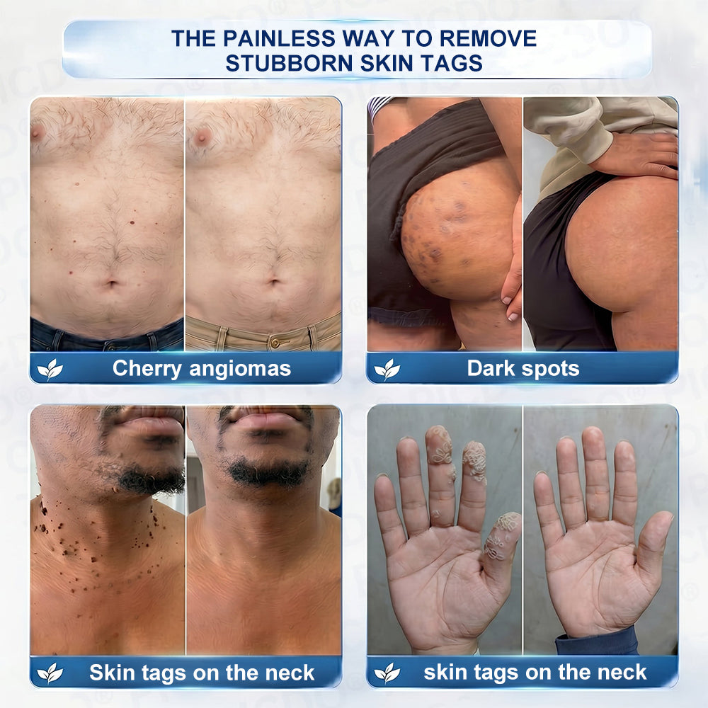 Purelora®  7-Day Skin Tag & Blemish Removal Cream (Painless Formula – Scar-Free)🌹🌹