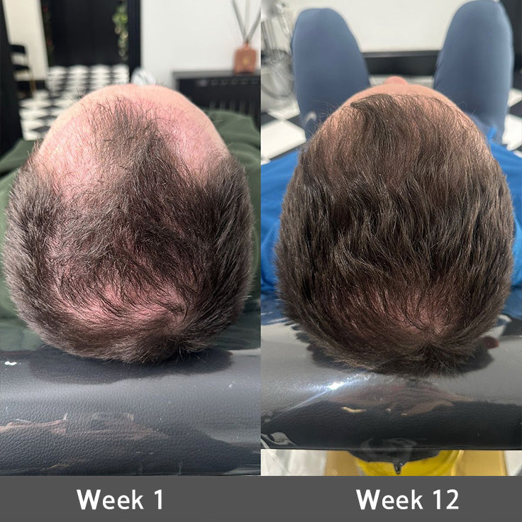 🌿👨‍⚕️ Official Australian Flagship Store 🇦🇺 | 🔥PURELORA® Onion & Rosemary 2-in-1 Anti-Hair Loss & Growth Set — Infused with a 15x concentrated hair-growth active complex to help you achieve thicker, fuller, and stronger hair.