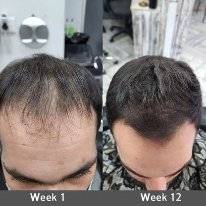 🌿👨‍⚕️ Official Australian Flagship Store 🇦🇺 | 🔥PURELORA® Onion & Rosemary 2-in-1 Anti-Hair Loss & Growth Set — Infused with a 15x concentrated hair-growth active complex to help you achieve thicker, fuller, and stronger hair.