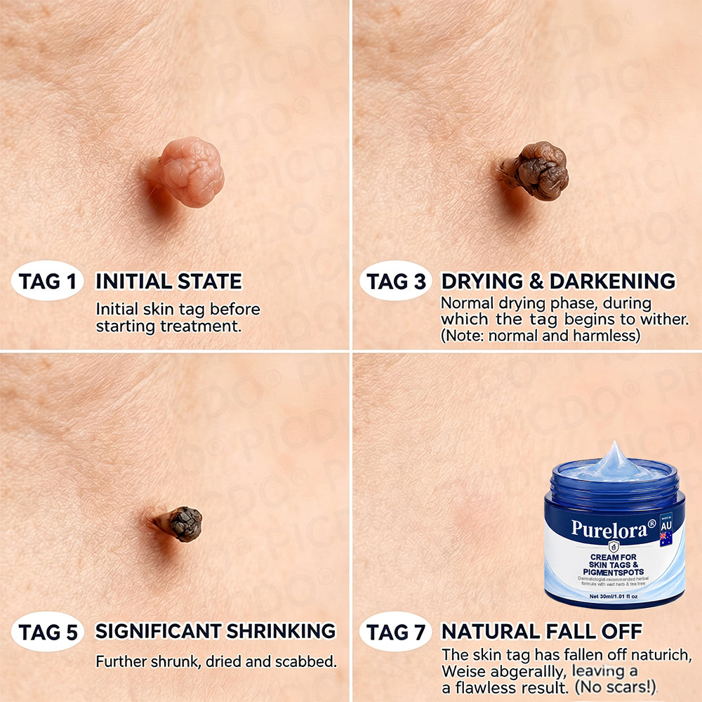 Purelora®  7-Day Skin Tag & Blemish Removal Cream (Painless Formula – Scar-Free)🌹🌹