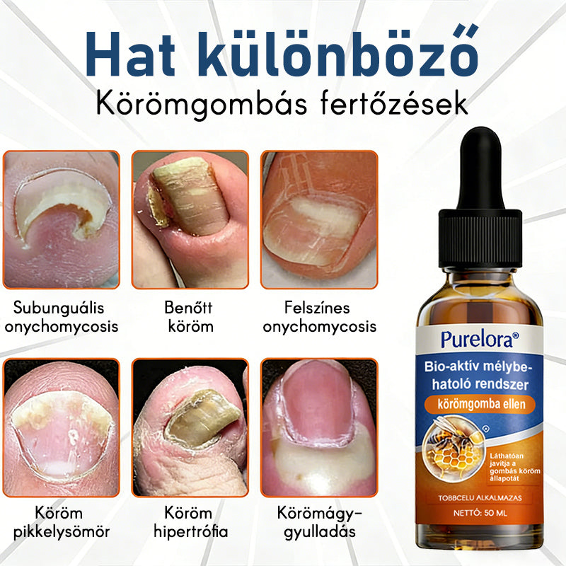 Purelora®Bioaktív Mélyen Behatoló Rendszer Körömgomba Ellen
