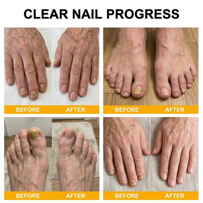 Purelora® Bee Venom Peptide Nail & Foot Repair Serum for nail fungus care, yellow nails, thick nails, and athlete’s foot recovery support.